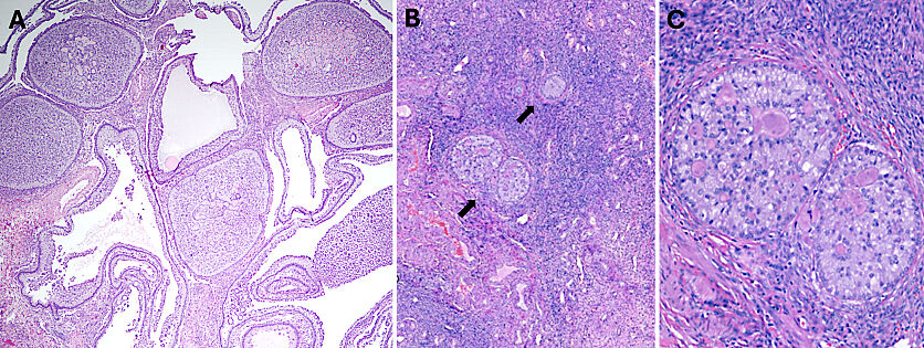 Pathology of Ovarian, Fallopian Tube and Primary Peritoneal